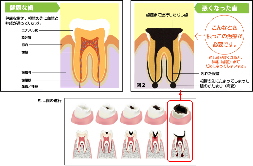 むし歯の進行