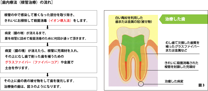 歯内療法（根管治療）の流れ