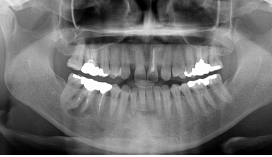 デジタルレントゲンで病変を発見