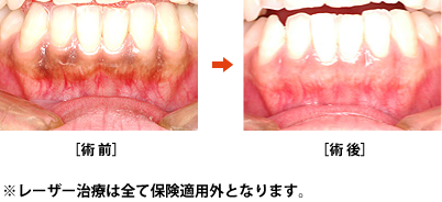 歯肉のメラニン色素沈着を除去する
