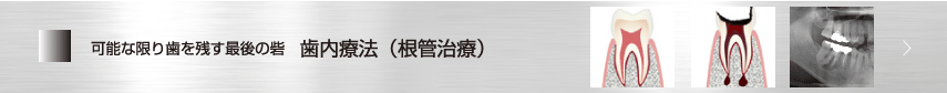 可能な限りはを残す最後の砦　歯内療法（根管治療）