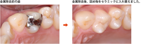 金属除去前の歯　金属除去後、詰め物をセラミックに入れ替えました。