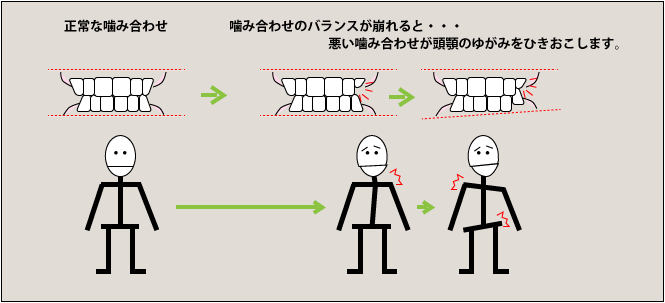 正常な噛み合わせ、噛み合わせのバランスが崩れると・・・悪いかみ合わせが顎のゆがみを引き起こします。